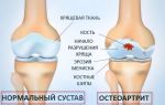Причины и современные методы лечения остеоартрита