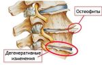 Как вылечить деформирующий спондилез шейного отдела позвоночника