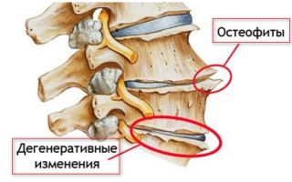 Как вылечить деформирующий спондилез шейного отдела позвоночника