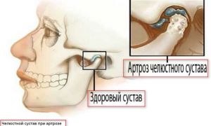 Симптомы и лечение артрита височно-нижечелюстного сустава (ВНЧС)