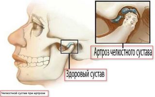 Симптомы и лечение артрита височно-нижечелюстного сустава (ВНЧС)