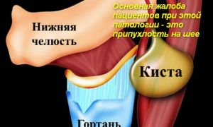 Как лечить кисту на шее