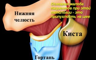 Как лечить кисту на шее